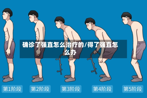 确诊了强直怎么治疗的/得了强直怎么办